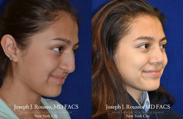 Rhinoplasty before/after photo 9