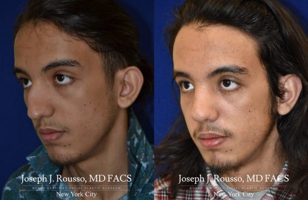 Rhinoplasty before/after photo 12