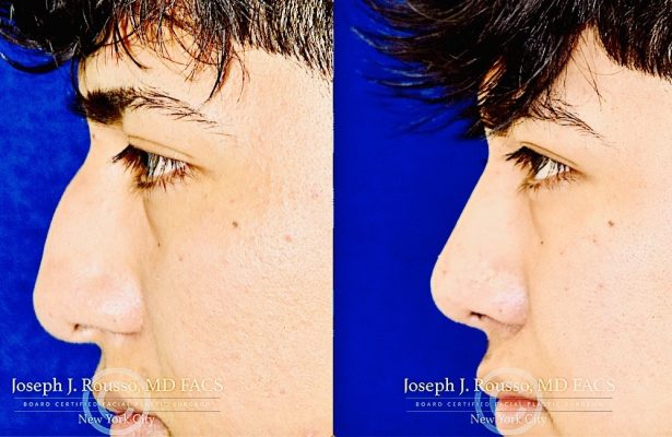 Male Rhinoplasty before/after photo 7