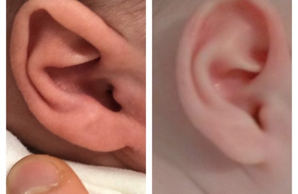 Ears & Microtia before/after photo 8