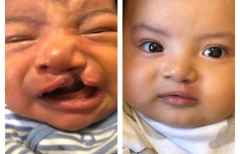 baby before and after cleft lip plastic surgeon new york, ny