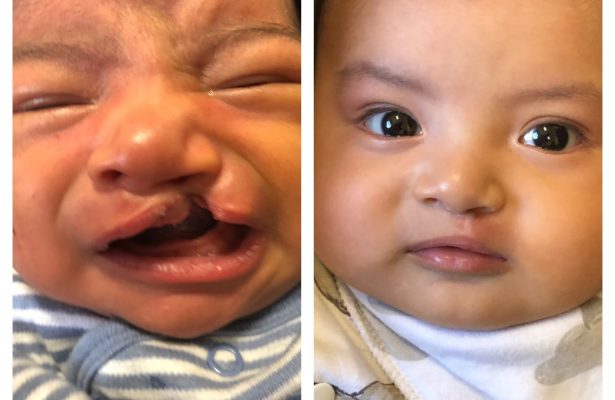 Cleft Lip & Palate before/after photo 10