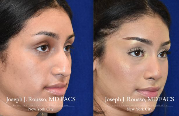 Rhinoplasty before/after photo 2