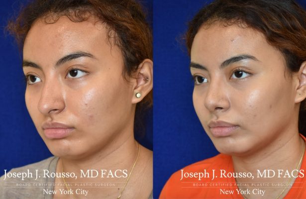 Rhinoplasty before/after photo 4