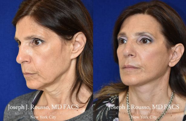 Facelift before/after photo 12