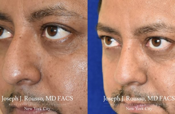 Male Rhinoplasty before/after photo 11