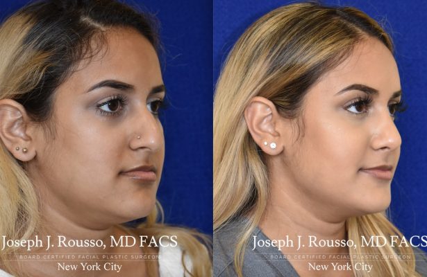 Rhinoplasty before/after photo 6