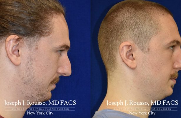 Male Rhinoplasty before/after photo 9
