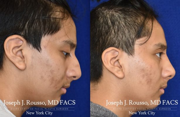 Male Rhinoplasty before/after photo 10