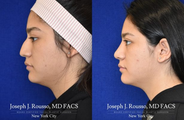 Rhinoplasty before/after photo 8