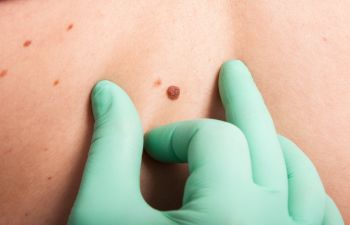 Mole Removal New York NY