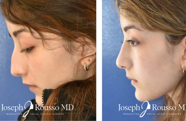 Rhinoplasty before/after photo 3