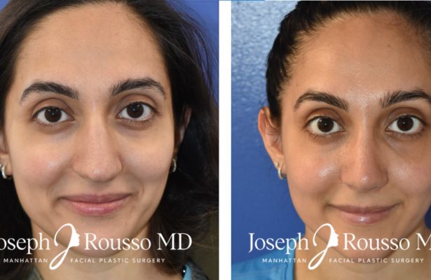 Rhinoplasty before/after photo 5