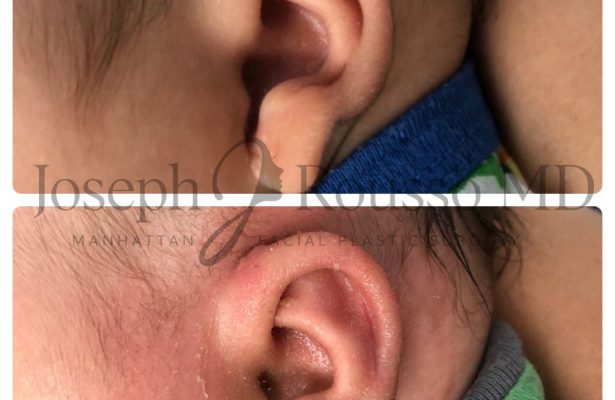 Ears & Microtia before/after photo 10