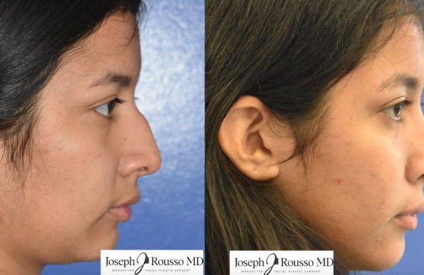 Female Rhinoplasty before/after photo 3