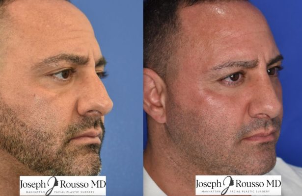 Male Rhinoplasty before/after photo 12