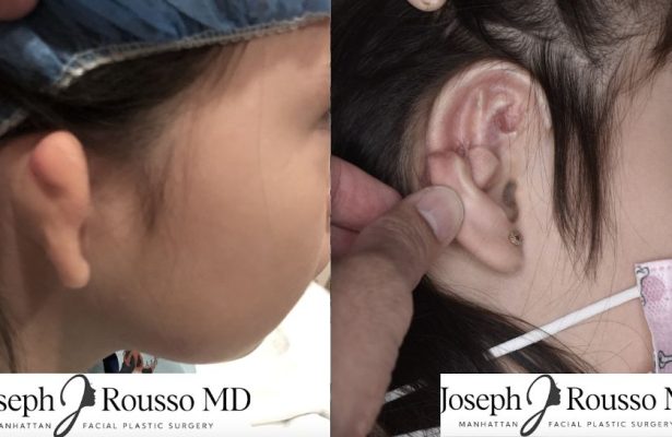 Ears & Microtia before/after photo 12