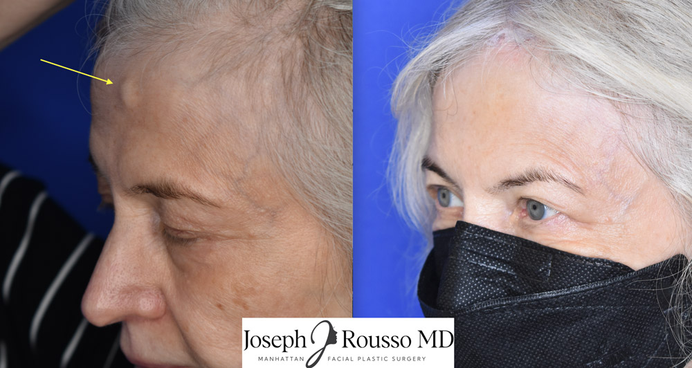 frontal osteoma removal before and after