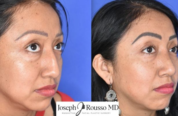 Female Rhinoplasty before/after photo 4