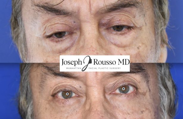 Blepharoplasty before/after photo 2