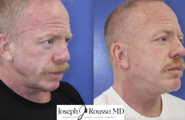 Facelift before/after photo 1