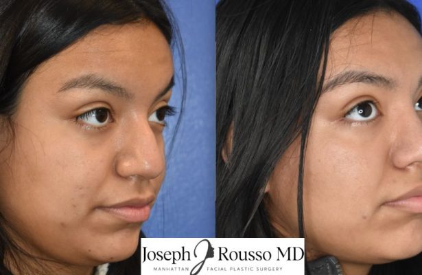 Rhinoplasty before/after photo 11