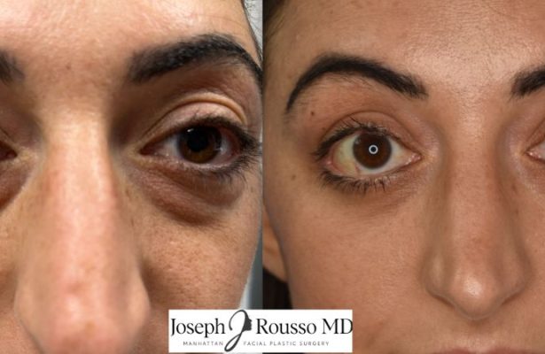 Blepharoplasty before/after photo 3