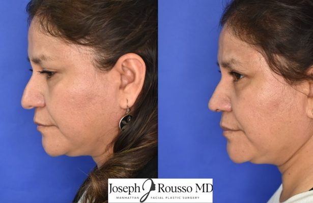 Female Rhinoplasty before/after photo 6