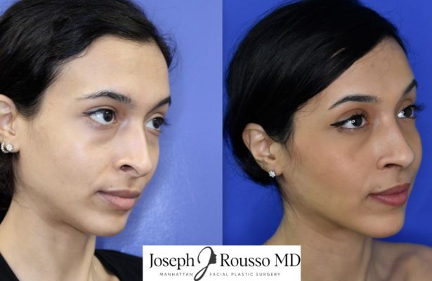 Female Rhinoplasty before/after photo 7