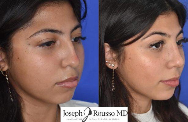 Female Rhinoplasty before/after photo 8