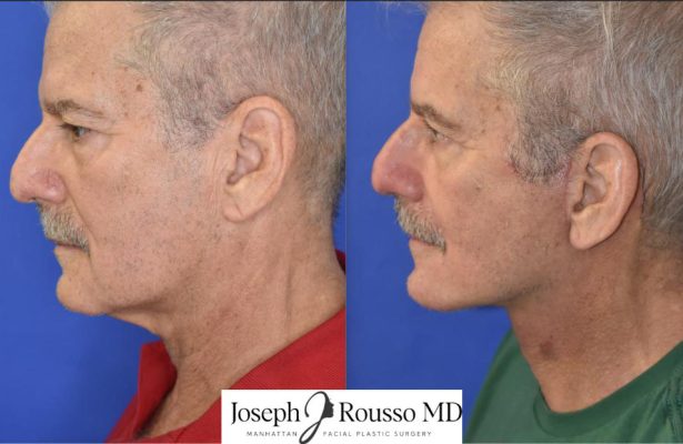 Facelift before/after photo 3