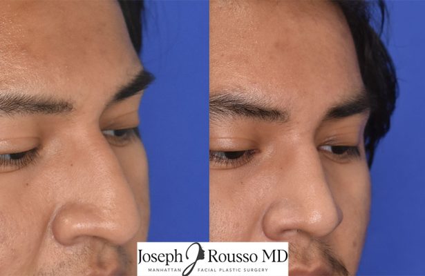 Male Rhinoplasty before/after photo 3