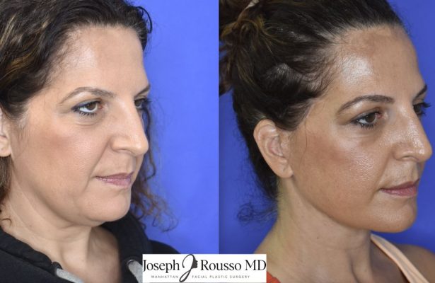 Facelift before/after photo 4