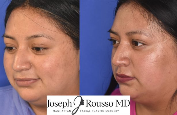 Female Rhinoplasty before/after photo 9