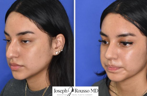 Female Rhinoplasty before/after photo 10